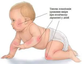 атопічний дерматит